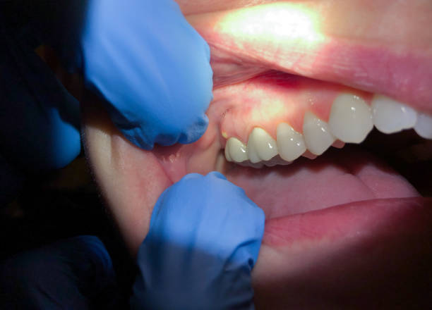 Best Broken or Cracked Tooth Emergency Dentist in Barry, IL